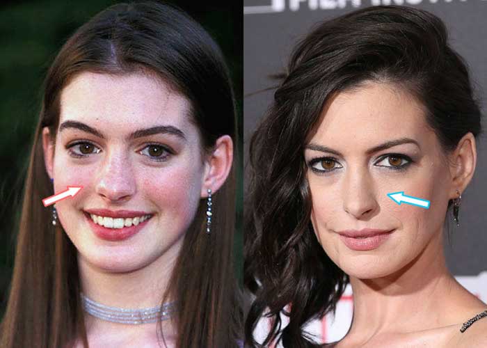 Anne Hathaway Plastic Surgery