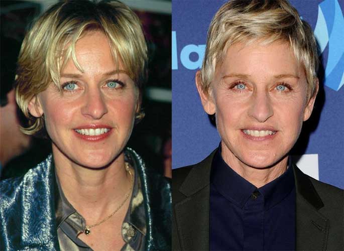 Ellen DeGeneres Plastic Surgery