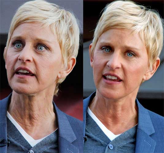 Ellen DeGeneres Plastic Surgery
