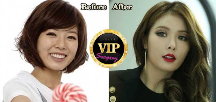 Kim Hyuna Plastic Surgery