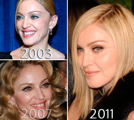 Madonna Plastic Surgery 