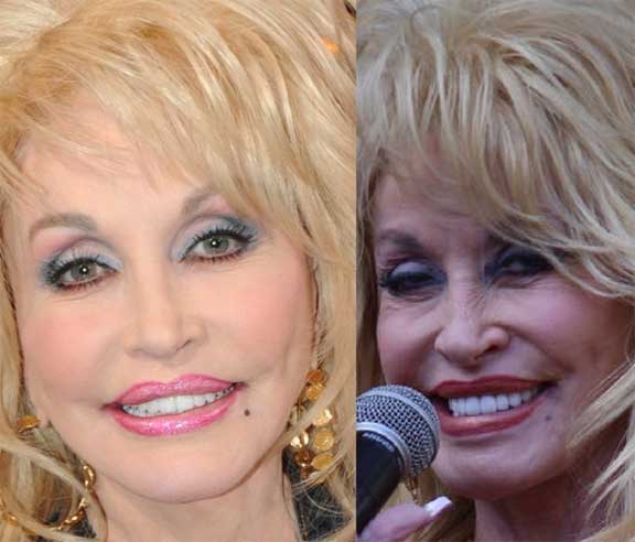 Dolly Parton Plastic Surgery 