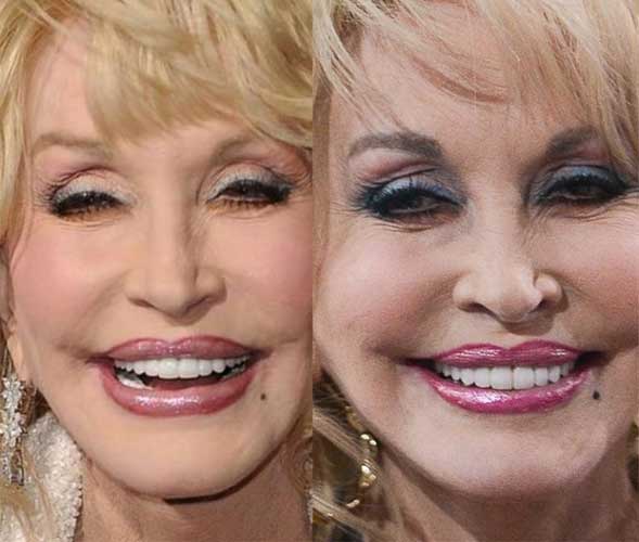 Dolly Parton Plastic Surgery 