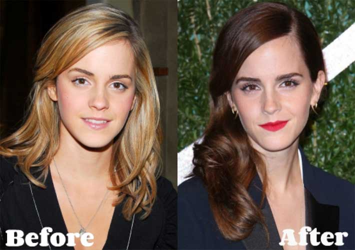 Emma Watson plastic surgery