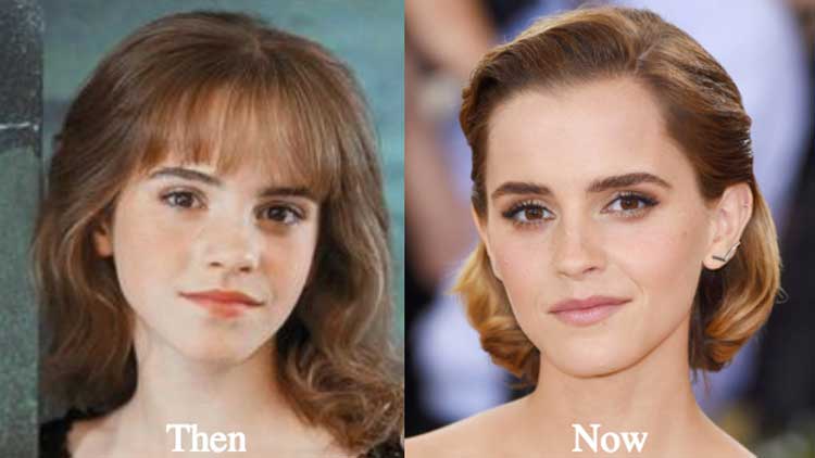 Emma Watson plastic surgery