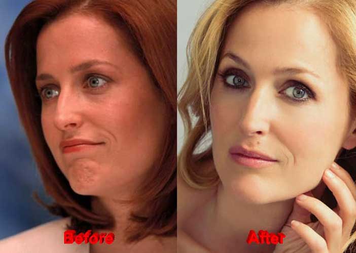 Gillian Anderson plastic surgery