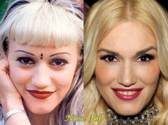 Gwen Stefani Plastic Surgery