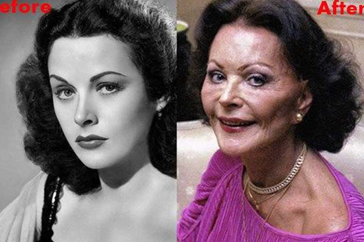 Hedy Lamarr Plastic Surgery 