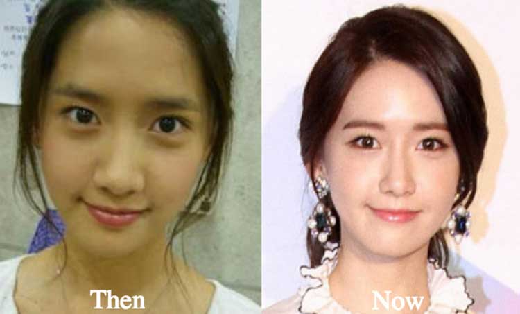 Yoona plastic surgery 