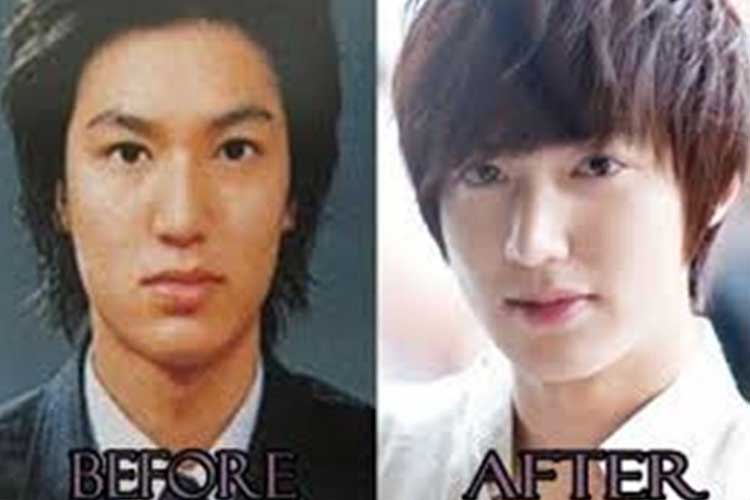 Lee Min Ho Plastic surgery