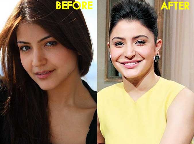 Anushka Sharma plastic surgery 