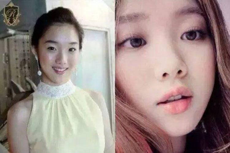 Lee Sung Kyung plastic surgery 