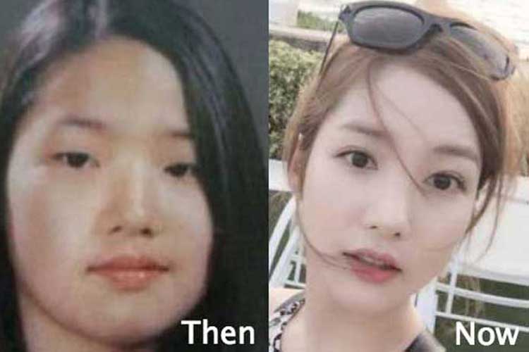 Park Min Young plastic surgery