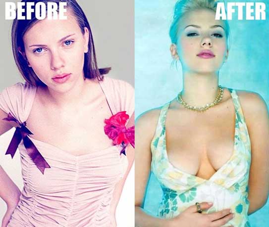 Scarlett Johansson Plastic Surgery 