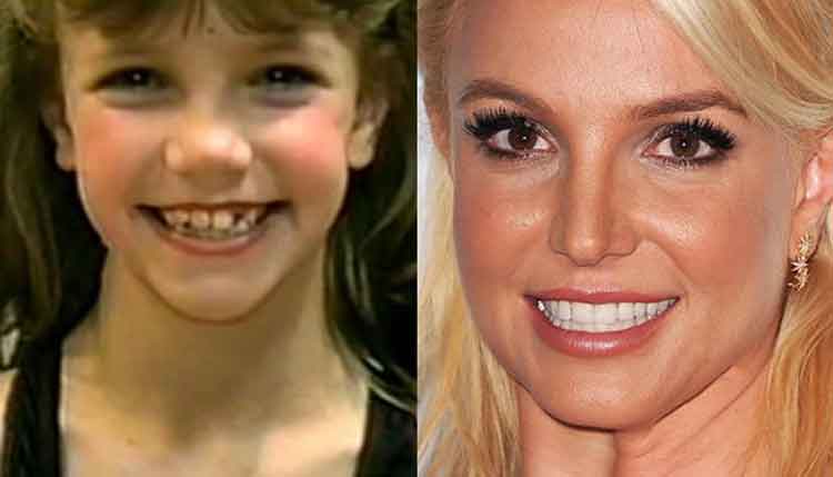 Britney Spears plastic surgery 