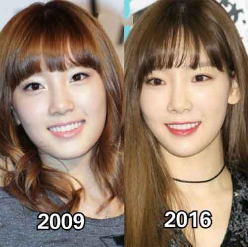 Kim Taeyeon plastic surgery