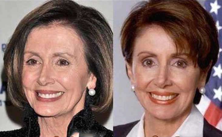 Nancy Pelosi Plastic Surgery