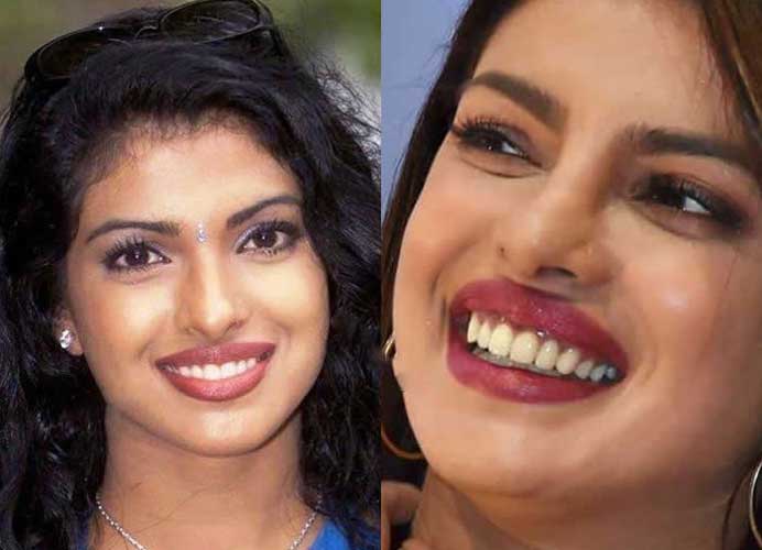 Priyanka Chopra plastic surgery