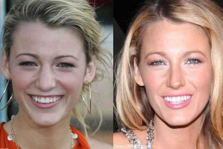Blake Lively Plastic Surgery Before And After