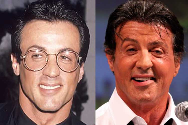 Sylvester Stallone Plastic Surgery Facelift, Botox and