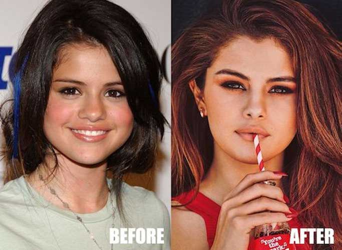 Selena Gomez Plastic Surgery 
