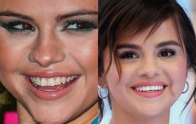 Selena Gomez Plastic Surgery 