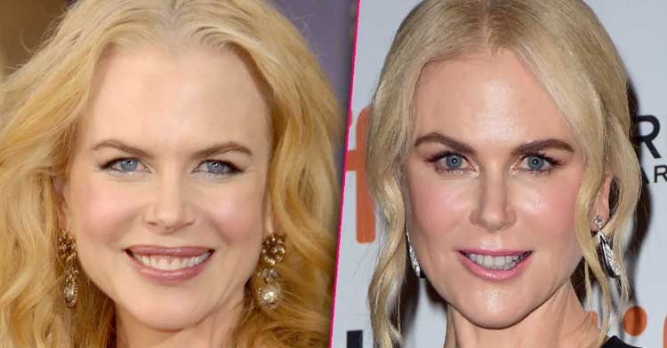 Nicole Kidman Plastic Surgery 