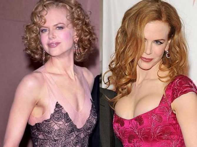 Nicole Kidman Plastic Surgery 