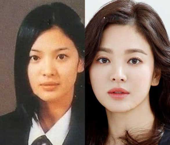 Song Hye Kyo Plastic Surgery