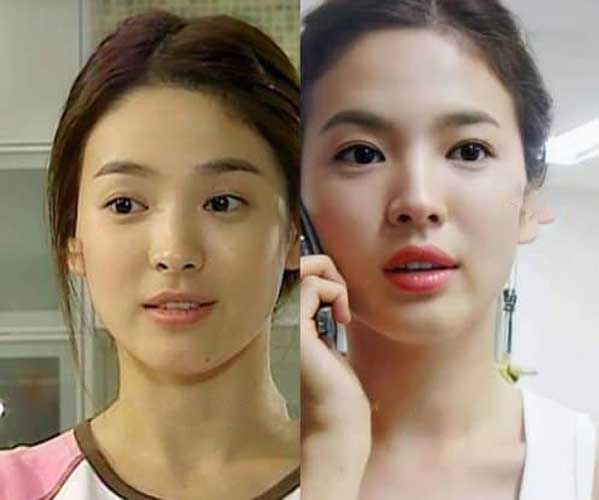 Song Hye Kyo Plastic Surgery