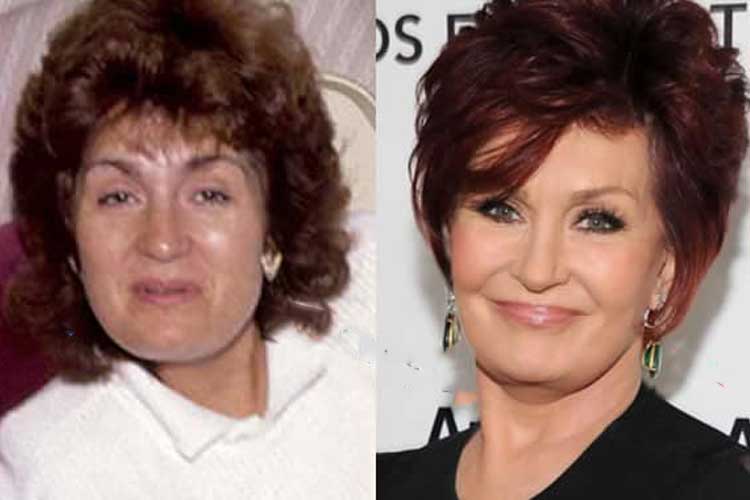 Sharon Osbourne Plastic Surgery 