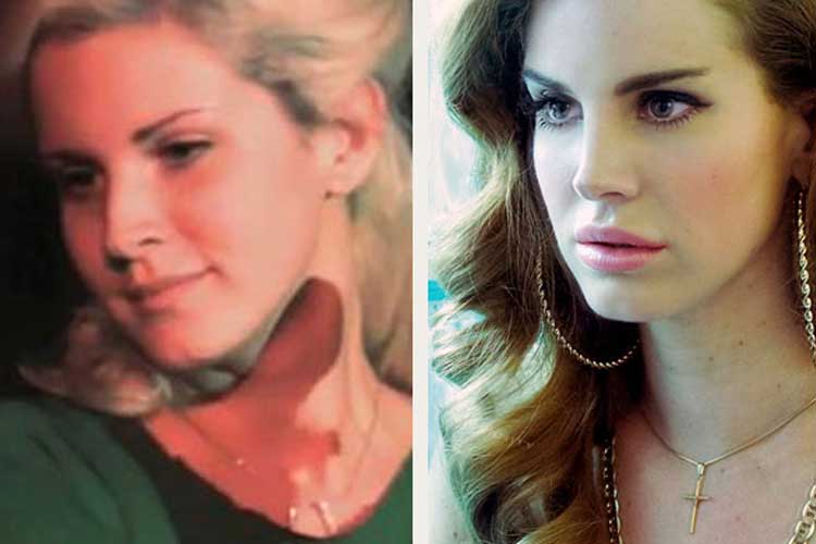 Lana Del Rey plastic surgery Lip Filler, Nose Job, Breast