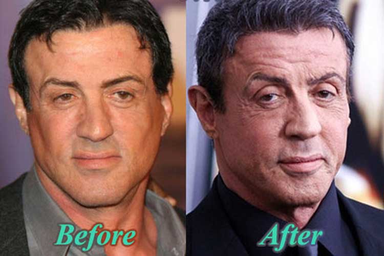 Sylvester Stallone Plastic Surgery Facelift, Botox, Nose Job
