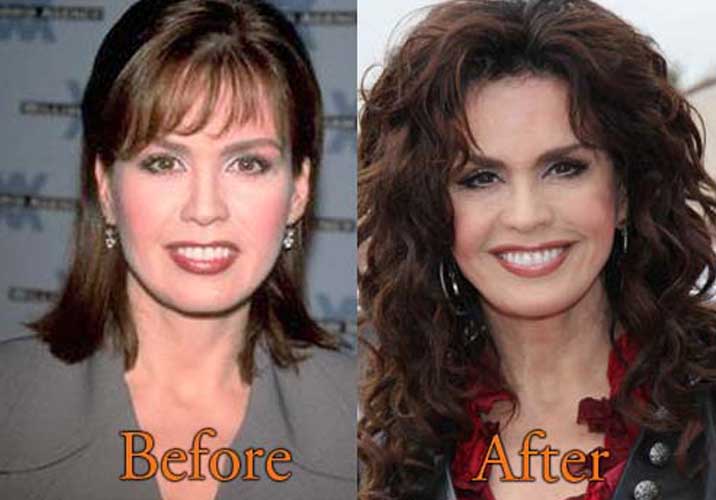 Marie Osmond Botox Related Keywords & Suggestions - Marie Os
