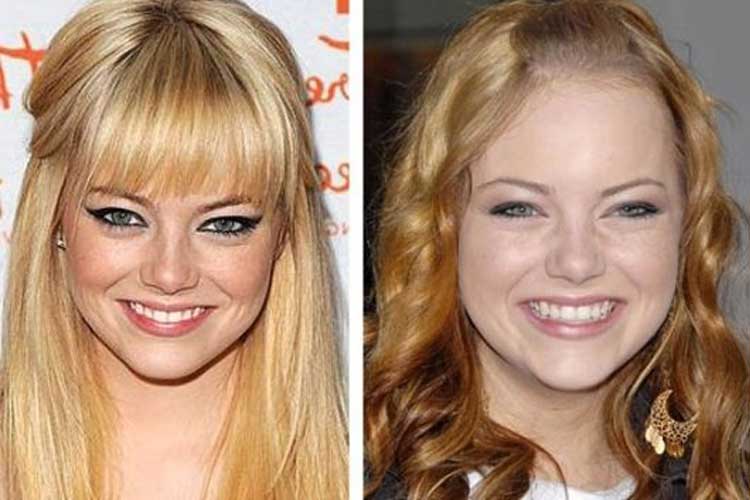 Emma Stone Plastic Surgery Nose Job Lip Filler Before And After.