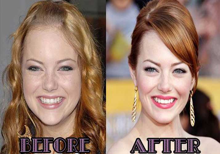 Emma Stone Plastic Surgery: Nose job, Lip filler, Before and After.